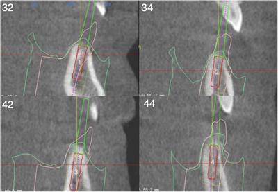 Immediate loading in partially edentulous patients with fixed implant-supported restorations cases report